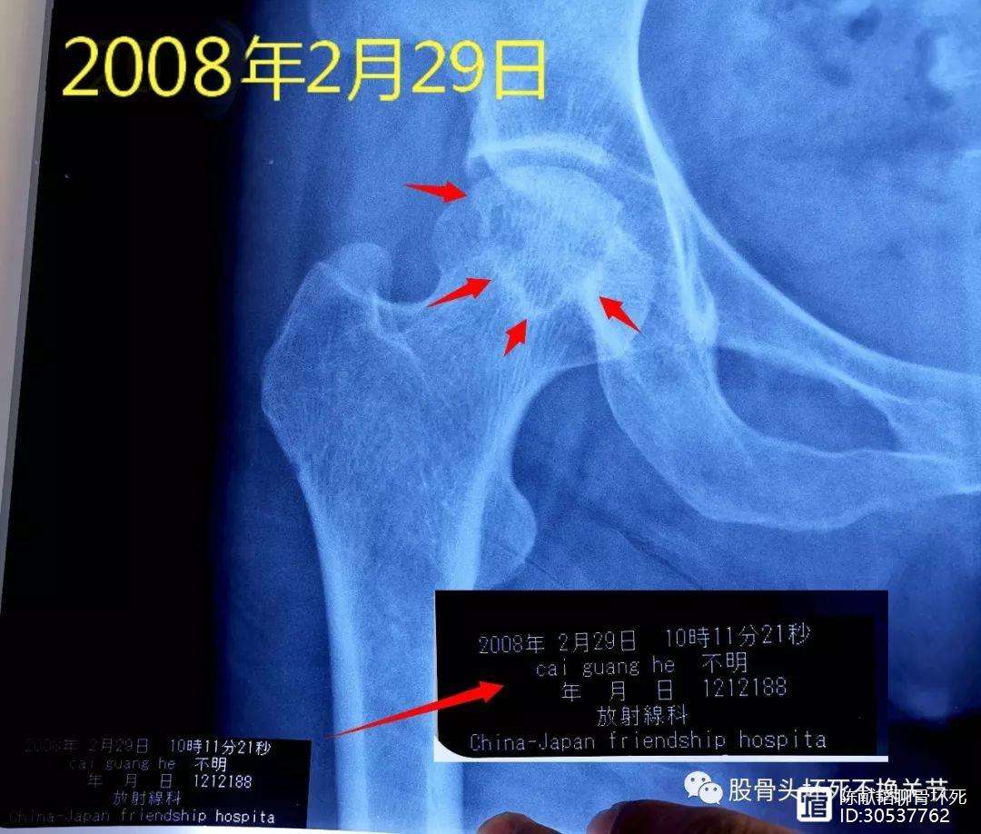 佳木斯人工骨头医保报销多少(人工骨头医保报销多少比例)